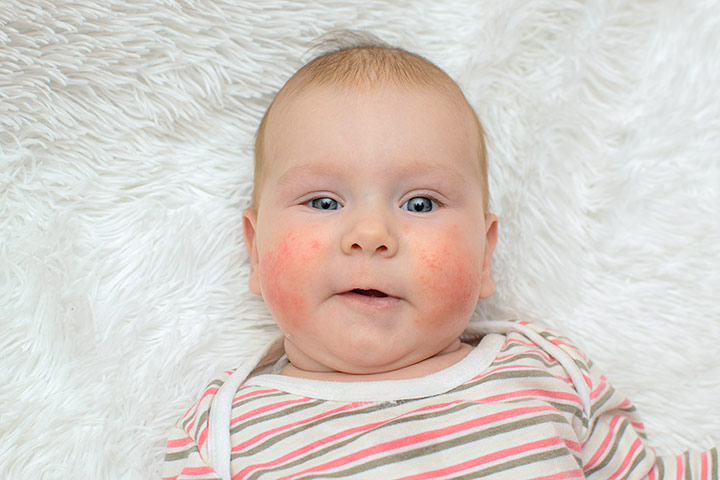 Allergie aux œufs chez les bébés