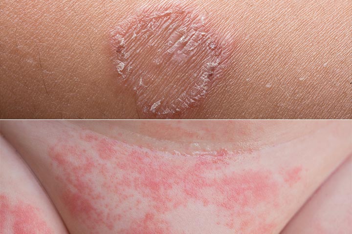  Les infections fongiques