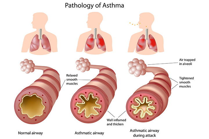 Qu'est-ce que l'asthme?