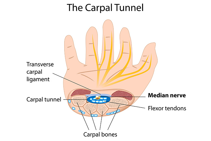 Qu'est-ce que le syndrome du canal carpien?