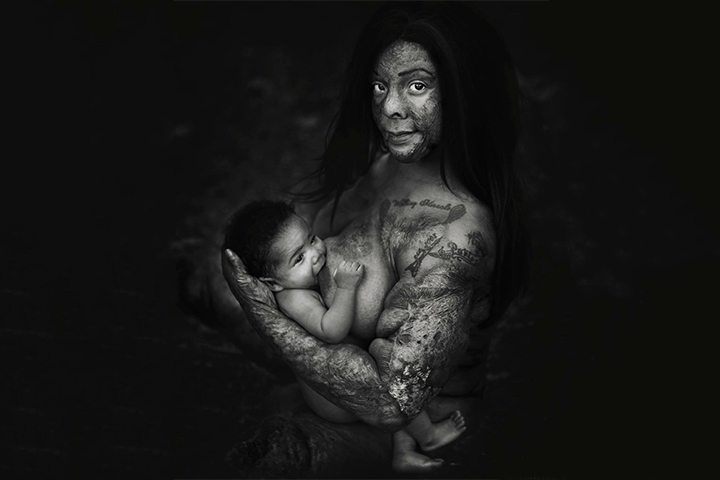 Mimi - Une survivante des brûlures, une mère et une guerrière!