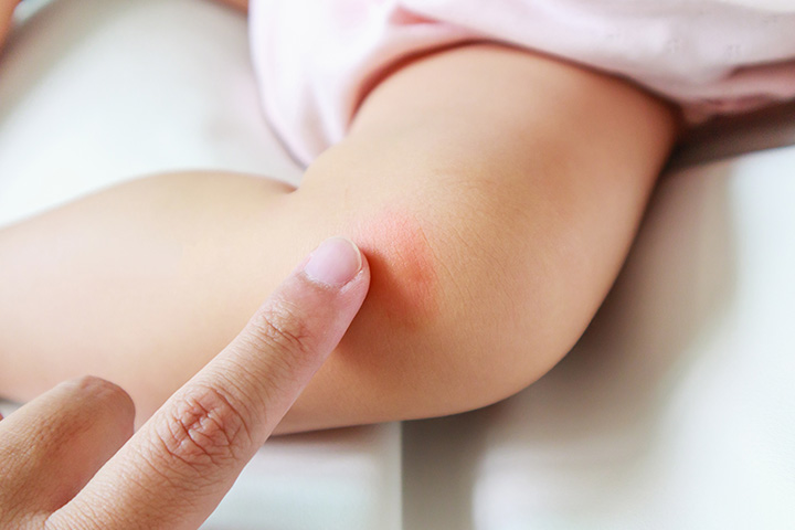 Eczéma chez les bébés