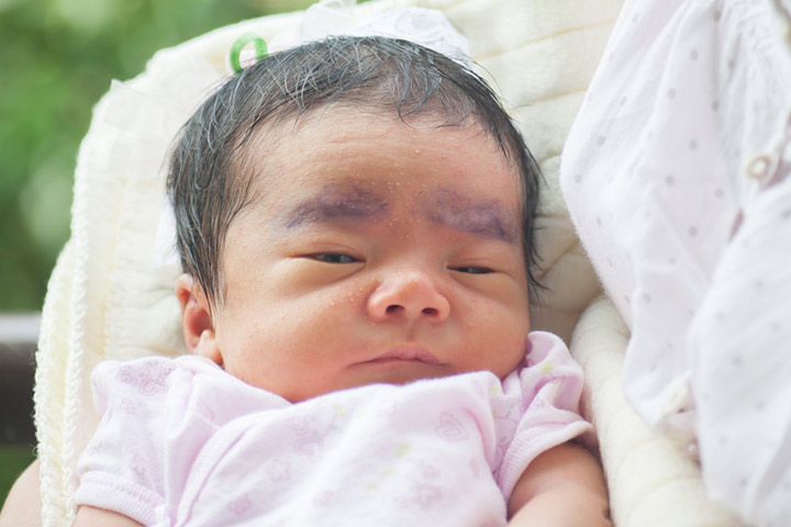 Miliaria cristallina ou sudamina