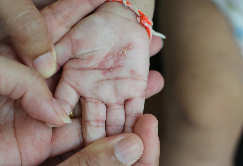 SCABIES "width =" 1024 "height =" 700 "srcset =" https://cdn.cdnparenting.com/articles/2018/06/759821887-H.jpg 1024w, https://cdn.cdnparenting.com/articles/ 2018/06/759821887-H-768x525.jpg 768w, https://cdn.cdnparenting.com/articles/2018/06/759821887-H-218x150.jpg 218w, https://cdn.cdnparenting.com/articles/ 2018/06/759821887-H-696x476.jpg 696w, https://cdn.cdnparenting.com/articles/2018/06/759821887-H-614x420.jpg 614w "tailles =" (largeur maximale: 1024px) 100vw, 1024px