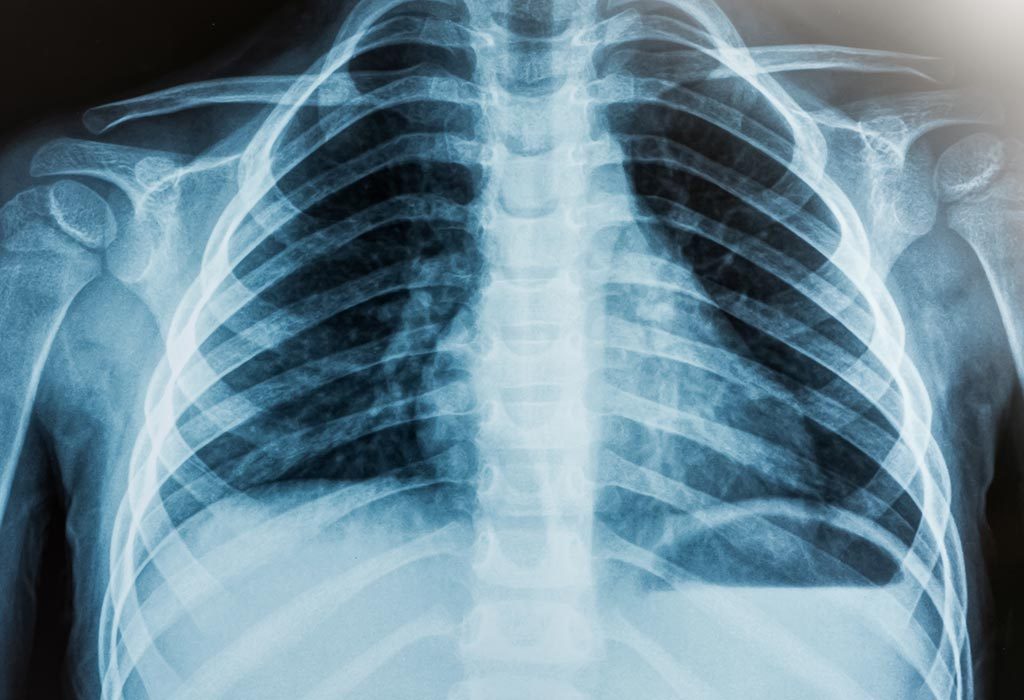 X-RAY CHEST "largeur =" 1024 "hauteur =" 700 "srcset =" https://cdn.cdnparenting.com/articles/2018/07/174049823-H.jpg 1024w, https://cdn.cdnparenting.com /articles/2018/07/174049823-H-768x525.jpg 768w, https://cdn.cdnparenting.com/articles/2018/07/174049823-H-218x150.jpg 218w, https://cdn.cdnparenting.com /articles/2018/07/174049823-H-696x476.jpg 696w, https://cdn.cdnparenting.com/articles/2018/07/174049823-H-614x420.jpg 614w "tailles =" (largeur maximale: 1024px) 100vw, 1024px