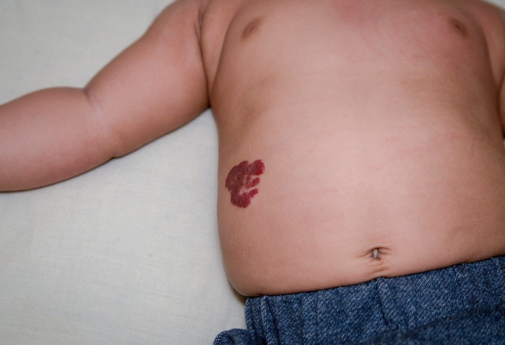 Un bébé atteint d'hémangiome infantile