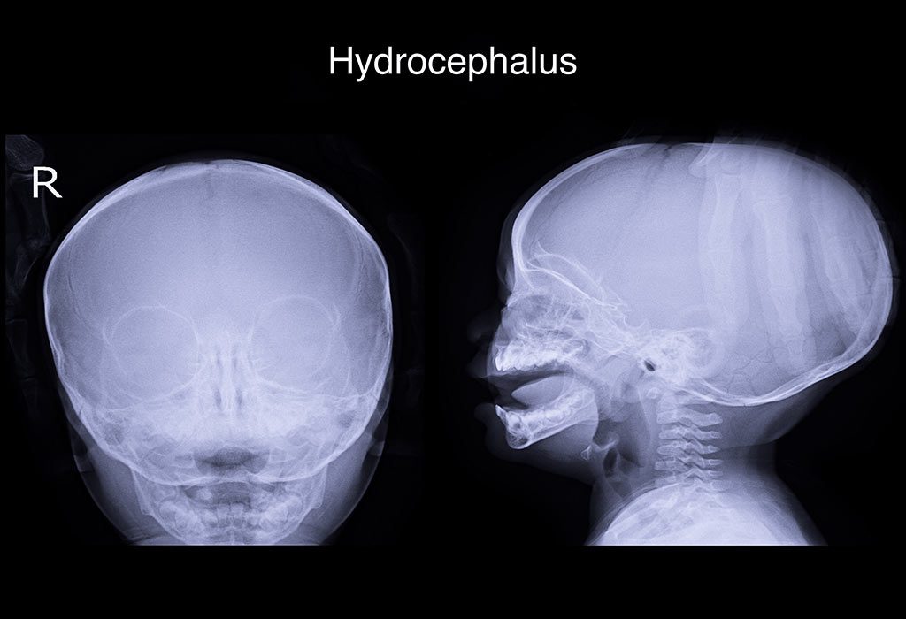 Hydrocéphalie chez les nourrissons 9 QU