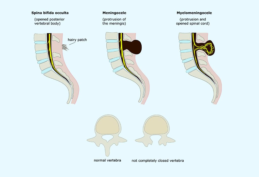 Hydrocéphalie chez les nourrissons 10 SPINA BIFIDA "width =" 1024 "height =" 700 "srcset =" https://cdn.cdnparenting.com/articles/2018/06/318856385-H.jpg 1024w, https://cdn.cdnparenting.com/articles /2018/06/318856385-H-768x525.jpg 768w, https://cdn.cdnparenting.com/articles/2018/06/318856385-H-218x150.jpg 218w, https://cdn.cdnparenting.com/articles /2018/06/318856385-H-696x476.jpg 696w, https://cdn.cdnparenting.com/articles/2018/06/318856385-H-614x420.jpg 614w "tailles =" (largeur maximale: 1024px) 100vw 1024px