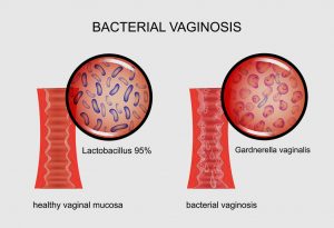 INFECTION VAGINALE "width =" 1160 "height =" 793 "srcset =" https://dinerados.com/wp-content/uploads/2020/05/1589375370_982_Enfermedades-inflamatoria-pelvicas-PID-causas-sintomas-y-tra treatment. jpg 300w, https://cdn.cdnparenting.com /articles/2018/01/556874716-H-768x525.jpg 768w, https://cdn.cdnparenting.com/articles/2018/01/556874716-H.jpg 1024w , https://cdn.cdnparenting.com/articles /2018/01/556874716-H-218x150.jpg 218w, https://cdn.cdnparenting.com/articles/2018/01/556874716-H-696x476.jpg 696w , https://cdn.cdnparenting.com/articles /2018/01/556874716-H-614x420.jpg 614w "tailles =" (largeur maximale: 1160px) 100vw, 1160px