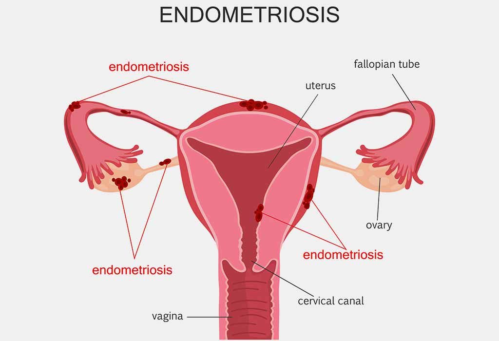 Infertilité féminine: causes, signes et remèdes maison 24 Endométriose "width =" 1024 "height =" 700 "srcset =" https://cdn.cdnparenting.com/articles/2018/01/22120153/653139685-H.jpg 1024w, https://cdn.cdnparenting.com/ articles / 2018/01/22120153/653139685-H-768x525.jpg 768w, https://cdn.cdnparenting.com/articles/2018/01/22120153/653139685-H-218x150.jpg 218w, https: // cdn. cdnparenting.com/articles/2018/01/22120153/653139685-H-696x476.jpg 696w, https://cdn.cdnparenting.com/articles/2018/01/22120153/653139685-H-614x420.jpg 614w "tailles = "(largeur maximale: 1024px) 100vw, 1024px