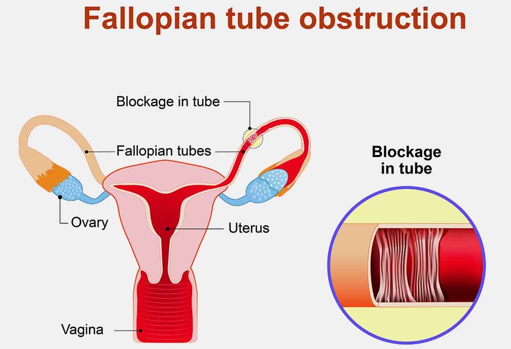 Infertilité féminine: causes, signes et remèdes maison 25 Facteurs des trompes de Fallope "width =" 1024 "height =" 700 "srcset =" https://cdn.cdnparenting.com/articles/2018/01/22120200/447187645-H.jpg 1024w, https: // cdn .cdnparenting. com / articles / 2018/01/22120200/447187645-H-768x525.jpg 768w, https://cdn.cdnparenting.com/articles/2018/01/22120200/447187645-H-218x150.jpg 218w, https: // cdn.cdnparenting.com/articles/2018/01/22120200/447187645-H-696x476.jpg 696w, https://cdn.cdnparenting.com/articles/2018/01/22120200/447187645-H-614x420.jpg 614w " tailles = "(largeur maximale: 1024px) 100vw, 1024px