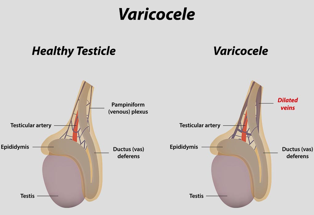 Représentation schématique de la varicocèle "width =" 1020 "height =" 700 "srcset =" https://pflegeboard.ch/fr/wp-content/uploads/2020/06/1589388925_432_Varicocele-e-infertilidad.jpg 1020w, https: // cdn .cdnparenting .com / articles / 2018/06/29154428/229502131-H-768x527.jpg 768w, https://cdn.cdnparenting.com/articles/2018/06/29154428/229502131-H-100x70.jpg 100w, https : / /cdn.cdnparenting.com/articles/2018/06/29154428/229502131-H-218x150.jpg 218w, https://cdn.cdnparenting.com/articles/2018/06/29154428/229502131-H-696x478. jpg 696w, https://cdn.cdnparenting.com/articles/2018/06/29154428/229502131-H-612x420.jpg 612w "tailles =" (largeur maximale: 1020px) 100vw, 1020px