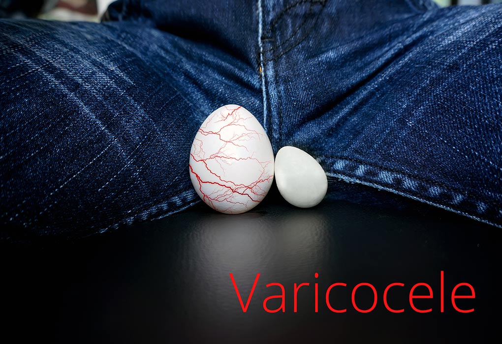 Varicocèle et infertilité