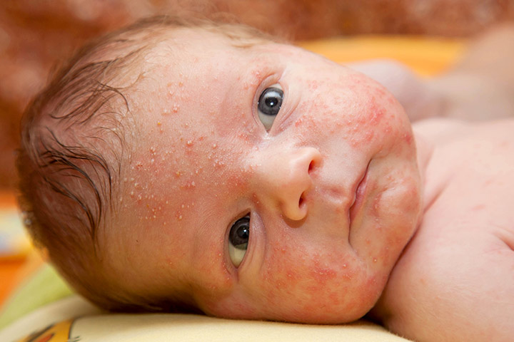 brûler un bébé