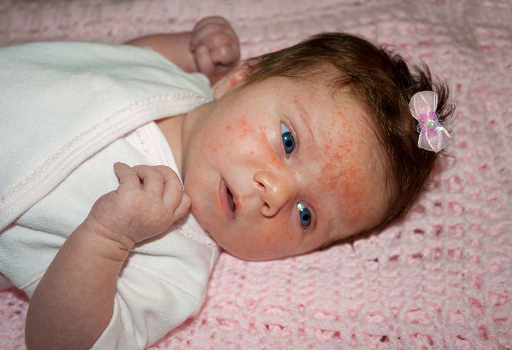 8 remèdes maison pour une éruption cutanée sur le visage de bébé 3 8 remèdes maison pour une éruption cutanée sur bébé