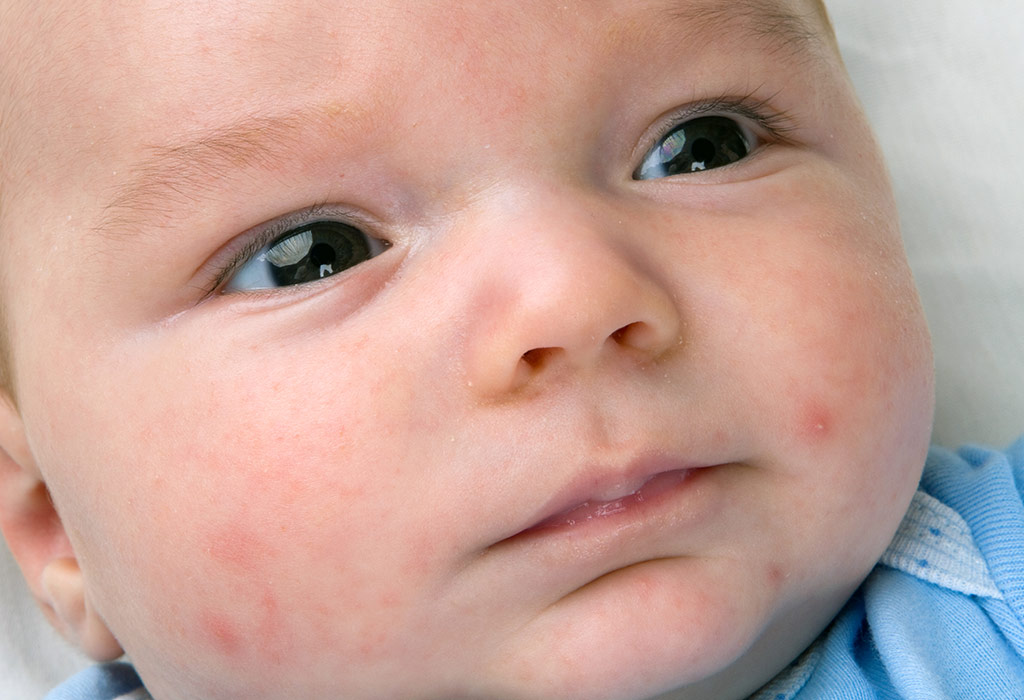 Acné de bébé - causes, symptômes et traitement