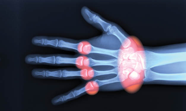Arthrite juvénile idiopathique (rhumatoïde) et son impact sur les enfants