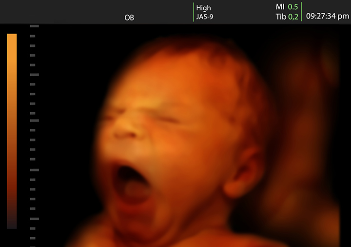 Les fœtus jamais vus bâiller in utero doivent regarder la vidéo