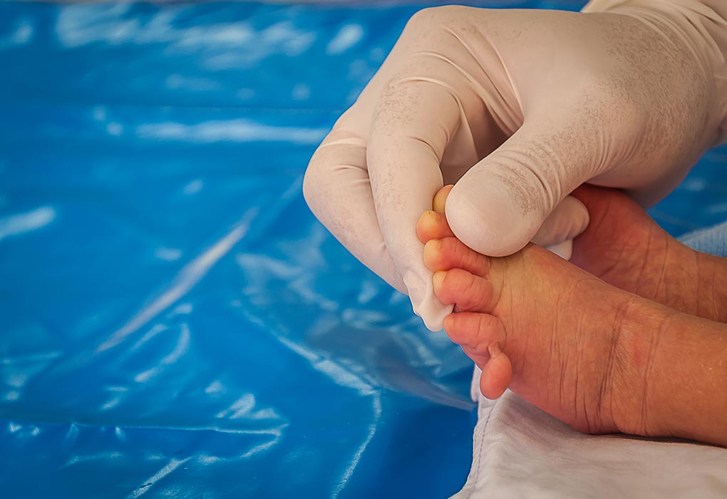 Bébé né avec des doigts et des orteils supplémentaires (polydactylie)