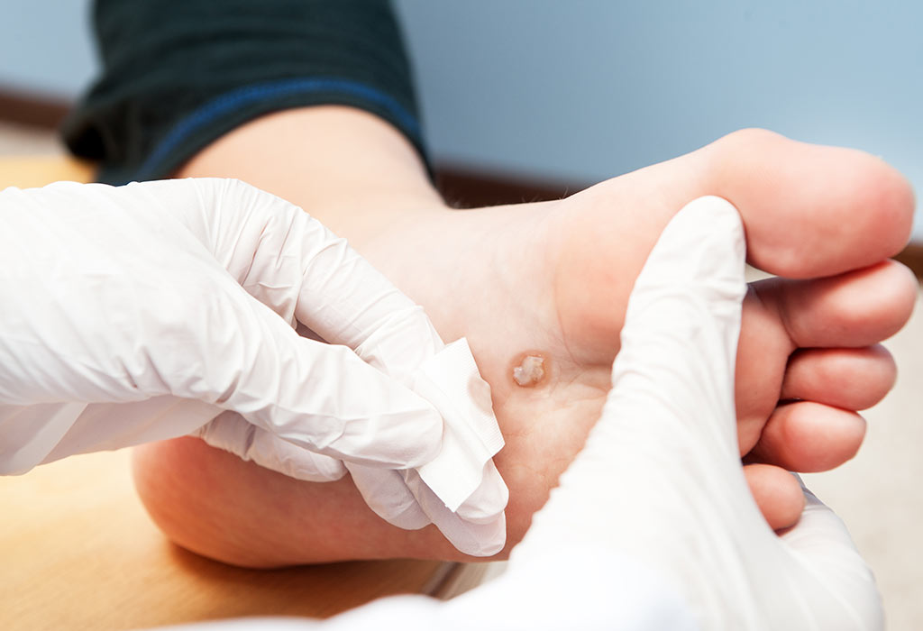 Comment faire face aux verrues chez les bébés 8 Verrues aux pieds