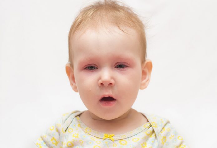 Un bébé malade aux yeux rouges. 