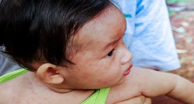 Des millions d'enfants font face au risque de rougeole alors que les pays suspendent la vaccination en raison de la pandémie de COVID-19 2 Rougeole