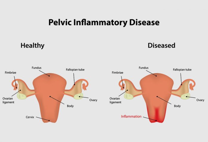 MALADIE INFLAMMATOIRE PELVIENNE 