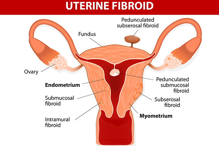 fibromes utérins et grossesse