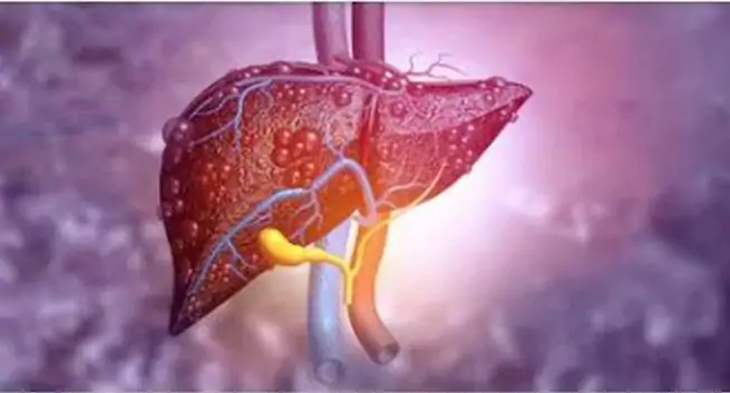 cancer du foie