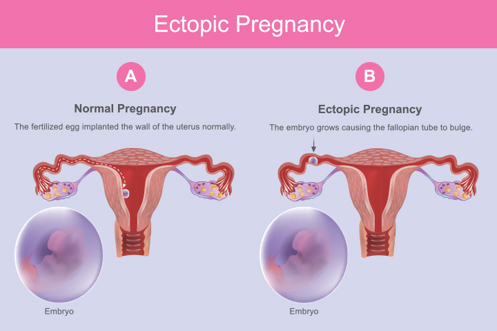Causes, symptômes et traitement de la grossesse extra-utérine