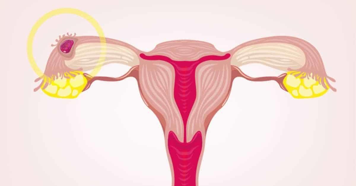 Grossesse extra-utérine: symptômes, signes et traitement