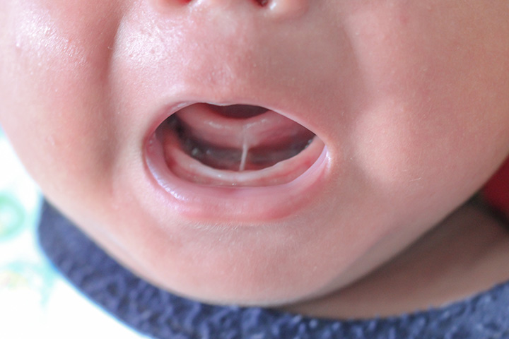 Langue liée chez les bébés: causes, symptômes et traitement 7 Cravate de langue chez les bébés
