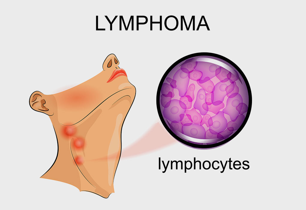 Lymphome chez les enfants - causes, diagnostic et traitement 7 Lymphome chez les enfants - causes, diagnostic et traitement