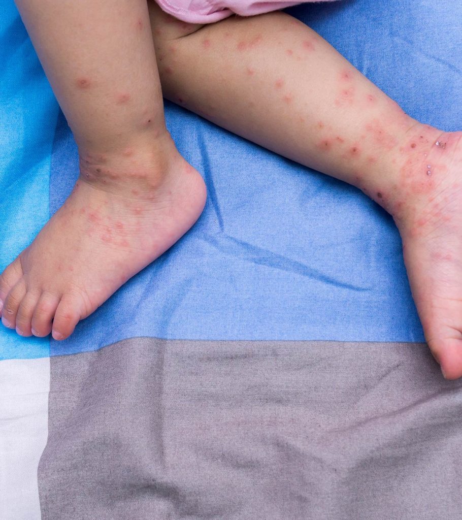 Maladie des mains, des pieds et de la bouche chez les bébés: causes, symptômes et remèdes maison 13 Maladie des mains, des pieds et de la bouche chez les bébés: causes, symptômes et remèdes maison