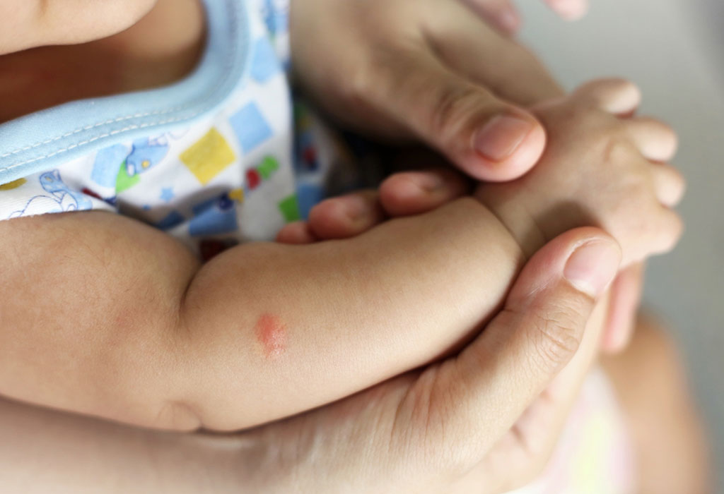 Piqûres de moustiques chez les bébés - Raisons et traitement