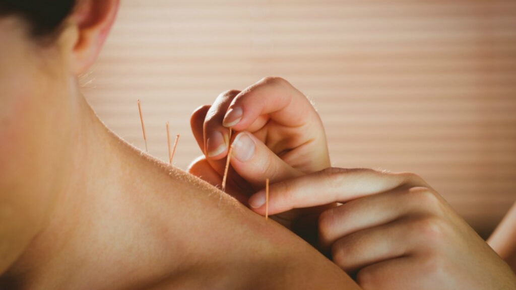 Une nouvelle étude éclaire l’impact de l’acupuncture sur la FIV 3 Une nouvelle étude éclaire l’impact de l’acupuncture sur la FIV
