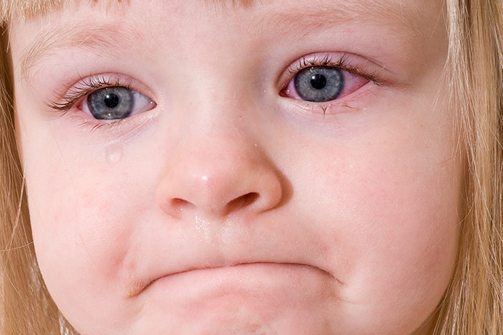 Oeil rose (conjonctivite) chez le jeune enfant: 3 causes, 8 symptômes et 4 traitements à connaître 3 oeil rose sur l'enfant