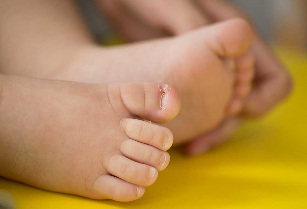 Ongle incarné chez les enfants - causes, symptômes et remèdes 7 Ongle incarné chez les enfants - causes, symptômes et remèdes