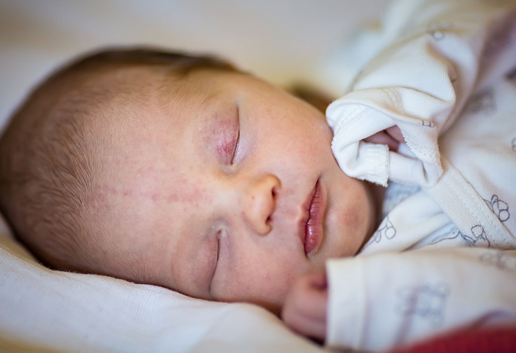 Patch de saumon (morsures de cigogne ou bisous d'ange) sur les nouveau-nés 5 BÉBÉ AVEC ÉCUSSONS DE SAUMON