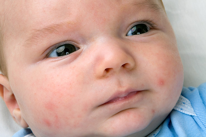 Pétéchies chez les bébés