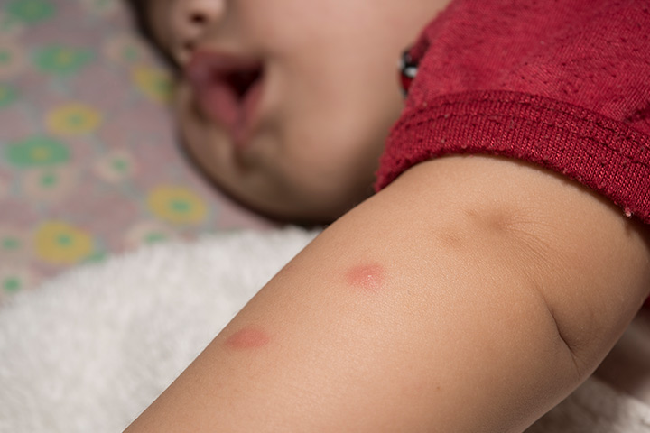 Piqûres de moustiques chez les bébés Symptômes, remèdes maison et prévention