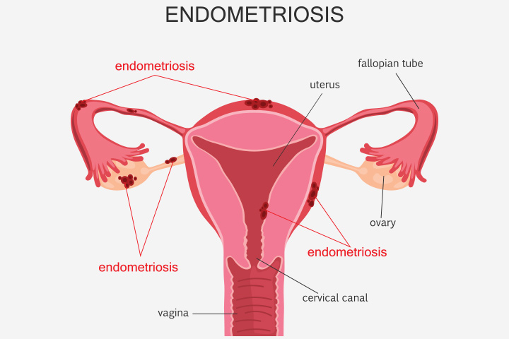 Pouvez-vous tomber enceinte avec l'endométriose? 6 Pouvez-vous tomber enceinte avec l'endométriose?