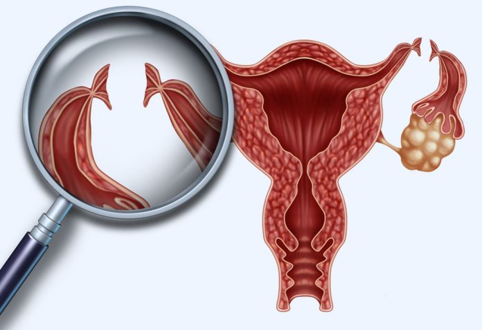 Tubal Ligation Reversal 