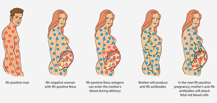 Rh ne correspond pas Qu'est-ce que cela signifie pour vous et votre bébé?