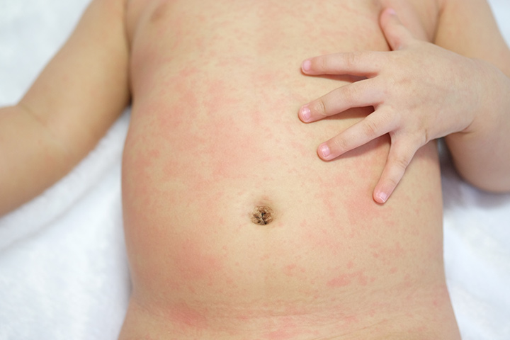 Roseola chez les jeunes enfants