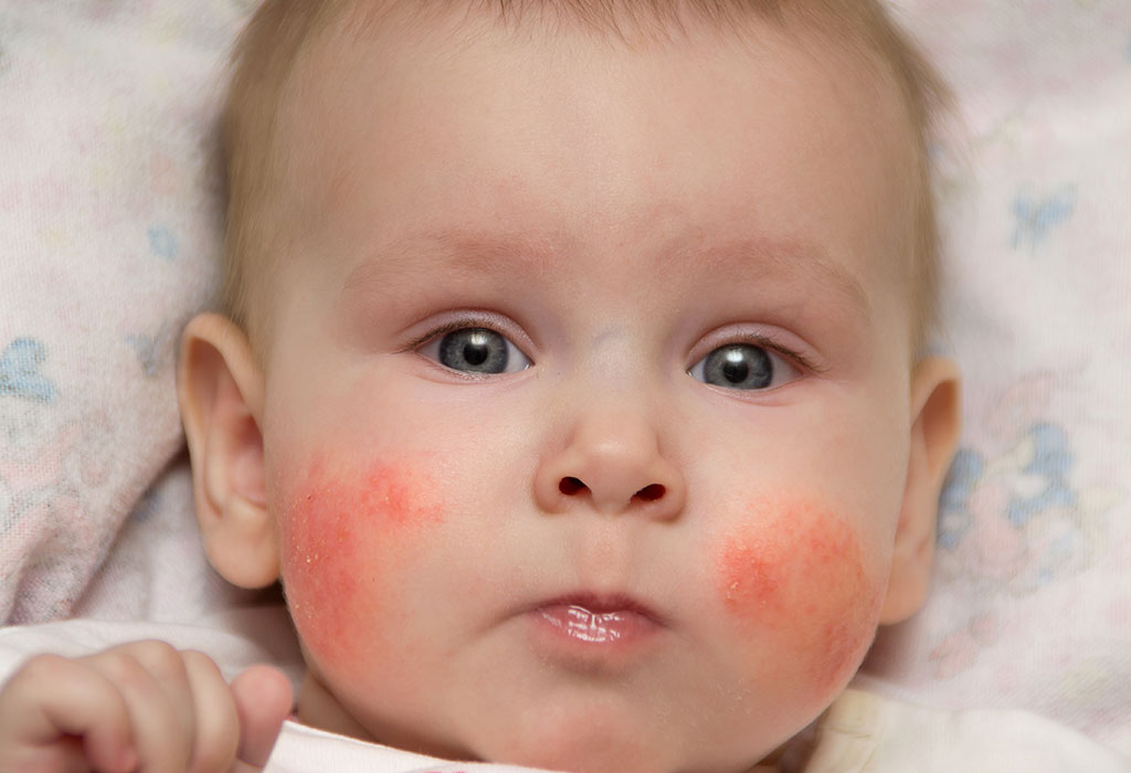 Éruption cutanée sur bébé