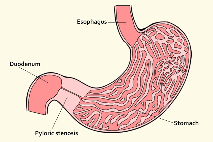 Sténose pylorique chez les bébés