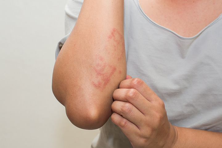 Urticaire post-partum: provoque des symptômes, un traitement et des remèdes 3 Urticaire post-partum