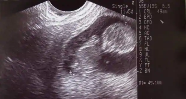 Votre analyse d'anomalie indique-t-elle que vous avez un placenta postérieur? Voici ce que cela signifie 7 échographie