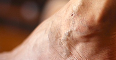 Avez-vous des varices? 5 À quoi s'attendre Logo